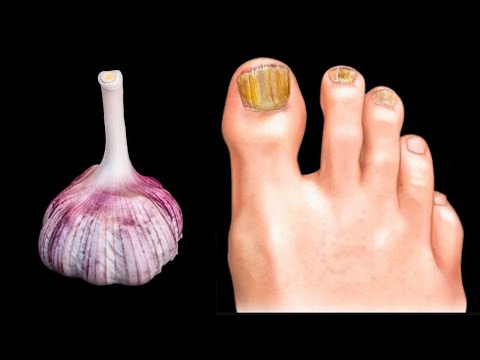 These 3 healthy recipes will help you get rid of nail fungus forever🔥 Garlic against nail fungus