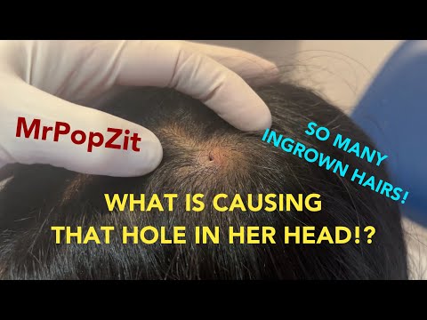 Interesting growth on the scalp, Pilar tumor. Must see how many hairs in tumor! Wait for mini pop.