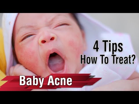 Baby Acne or Rash