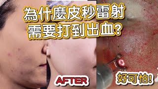 皮秒雷射治療痘疤打到出血好恐怖！莊盈彥醫師操作皮秒雷射非常專業！#Shorts