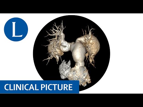 Recurrent pulmonary emboli with aneurysms: think vasculitis and Hughes Stovin syndrome