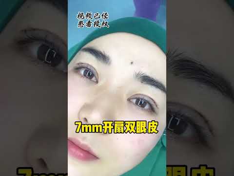 7mm的双眼皮👀平扇形做出妈生感还是挺完美的达到了双眼皮手术 全7mm妈生眼、自然灵动