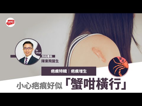 疤痕特輯｜疤痕增生｜小心疤痕好似蟹咁橫行 😨😨🦀