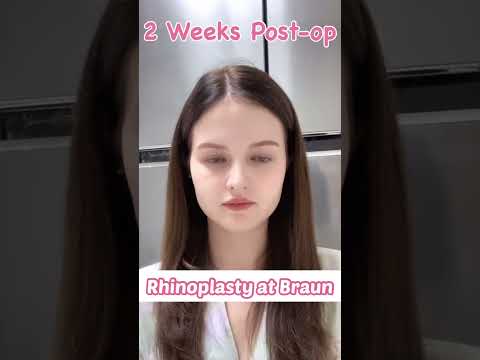 Rhinoplasty 1 month post -op😍