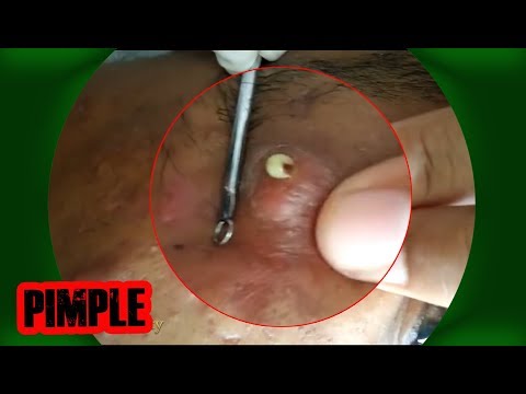 Best Pimple Popping Videos - Blackheads 2019 #10