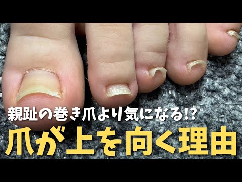 【巻き爪よりも気になる!?爪が上を向く理由】山形県寒河江巻き爪フットケアセンター　山形市・東根市・天童市からも多数来院中