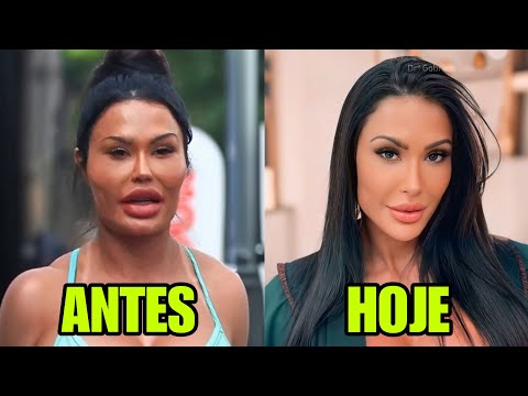 10 FAMOSOS QUE REVERTERAM HARMONIZAÇÃO FACIAL E CIRURGIAS PLÁSTICAS