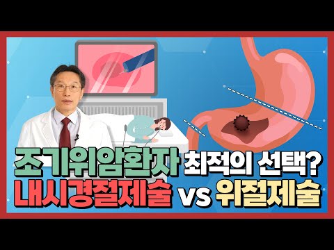 조기위암 환자에게 최적의 치료는 무엇일까?