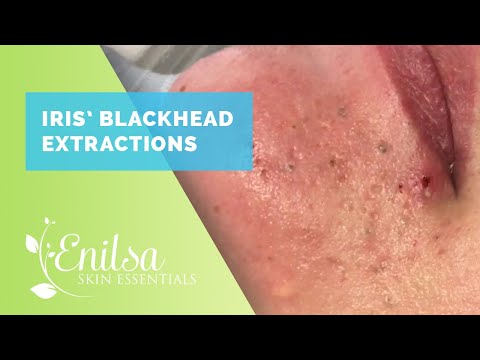 Iris Blackhead Extractions