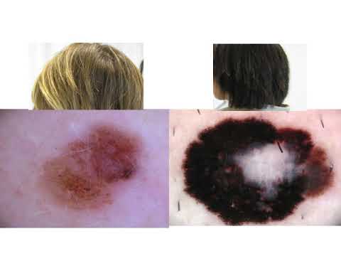 Melanoma and genetic traits - Dr. Susana Puig