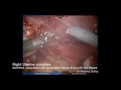 Robotic Hysterectomy made easy DR Rooma Sinha