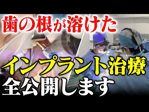 生まれつき歯がない患者のインプラント治療【先天性永久歯欠損】