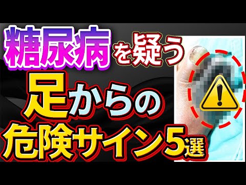 【放置厳禁！】絶対見逃してはいけない糖尿病を疑う足の症状5選について解説します。