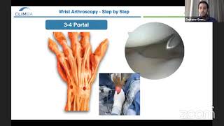 Wrist Arthroscopy: Step by Step