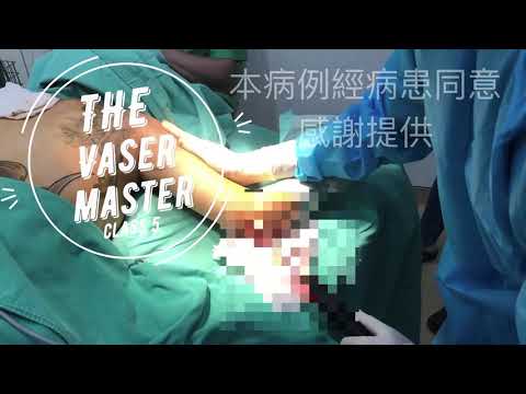 The Vaser master 威塑大師課第五堂 威塑進行中是否真的是溶解達到暢通無阻