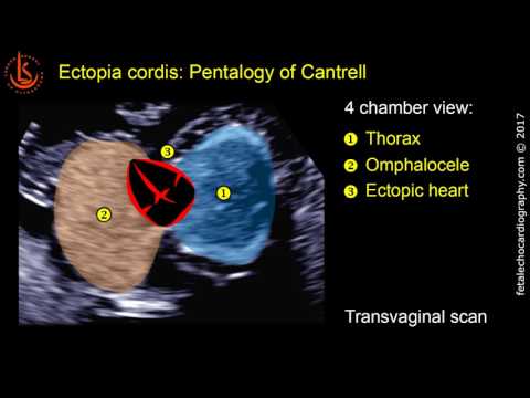 Fetal echocardiography at 11-13 weeks: Ectopia Cordis in Pentalogy of Cantrell