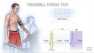 Mayo Clinic Minute: What is a cardiac stress test?