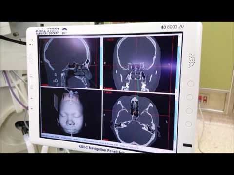 DEMO  Stereotactic Navigation System for Skull Base Endoscopic Surgery  Dr Ken Liao Liu