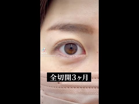 【全切開】埋没が取れて全切開したお客様。自然な末広二重希望。#shorts #二重整形