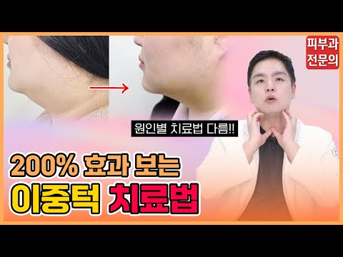 피부과 전문의가 알려주는 '이중턱'이 생기는 원인 4가지｜원인별 치료법, 시술