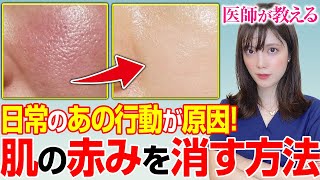 医師が教える！簡単に 肌の赤みを消す方法