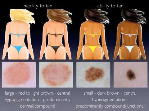 Nevus pattern in adults by Dr. Iris Zalaudek