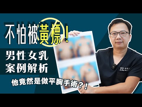 男性女乳手術新方法！手術效果好嗎？實際案例分析給你看！洪敏翔醫師｜諾雅整形外科