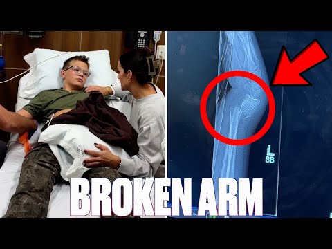 NOT WHAT WE MEANT BY FALL BREAK | BROKEN ARM | BOTH BONES BROKEN AT WRIST | BROKEN BONE ACCIDENT