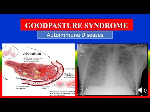 GOODPASTURE SYNDROME -  Definition, types, causes, pathophysiology, signs & symptoms, medicine