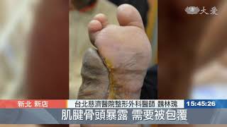 糖尿病足部潰瘍 清創修補術避免截肢