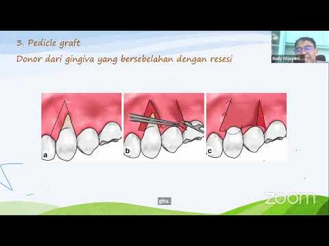 WEBINAR: Regenerative Periodontal Treatment As  Management Of Periodontitis