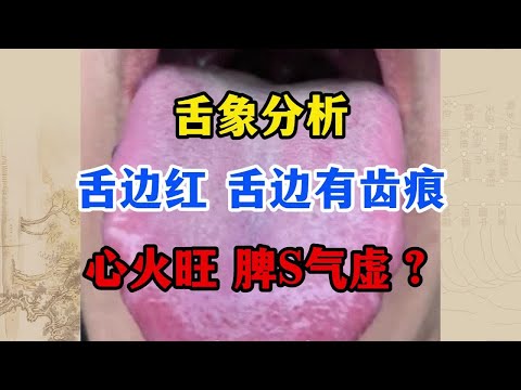 舌边红，舌边还有齿痕，这是脾虚湿气重吗？