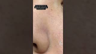 Effective blackheads removal.... #Tiktok #Skincare #Tiktokphilippines