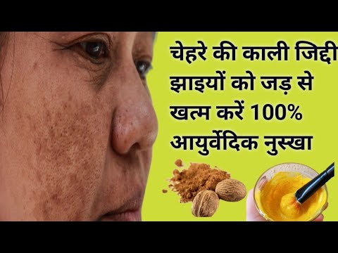 कितनी भी पुरानी जिद्दी झाइयां हो जड़ से खत्म करें मात्र 1 महीने में || how to remove pigmentation