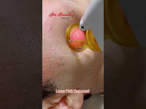 Laser Hair Removal #getsmarthairclub #hair #viralvideo