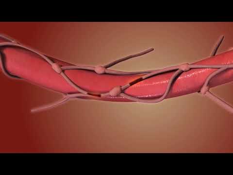 Esophagectomy. Esophagus Removal Animation