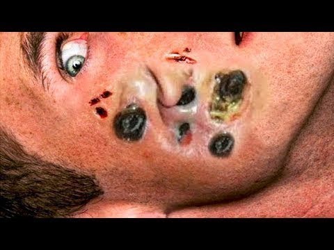 new blackhead extraction