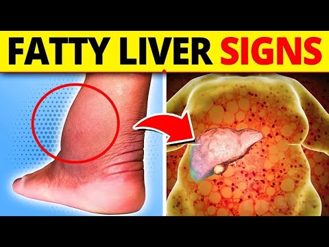 Don't Ignore These 10 Symptoms of Fatty Liver Disease