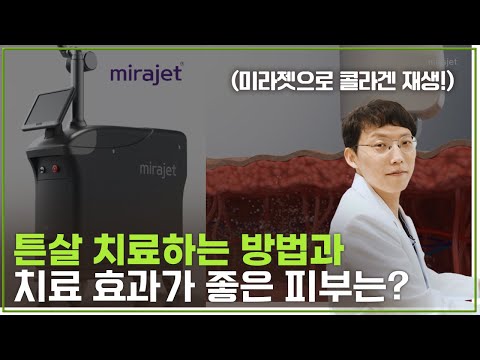 튼살 치료 시술 방법&과정과 치료가 잘 되는 피부는? (레이저 치료 미라젯)