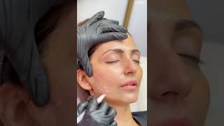 Hifu Treatment for Non-Surgical Facelift | High Intensity Focused Ultrasound Treatment