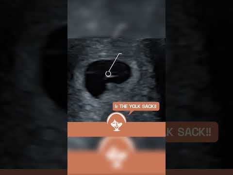 Yolk Sack and Heartbeat at 6 weeks #Pregnancy #EarlyDetection #ViabilityScan