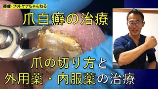 爪白癬の治療　爪の切り方と外用薬・内服薬の治療