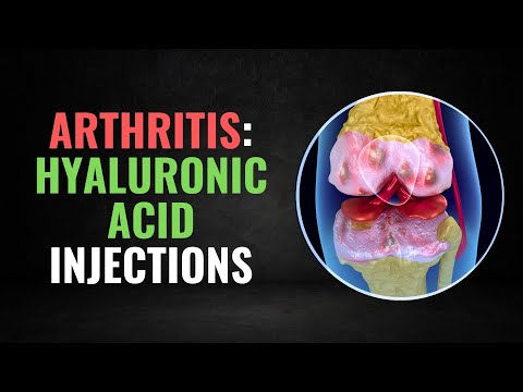 The Truth About Hyaluronic Acid Injections and Knee Arthritis