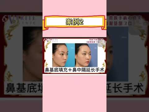 鼻基底填充术-改善中庭凹陷