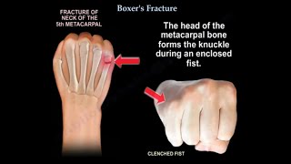 Boxer's Fracture.