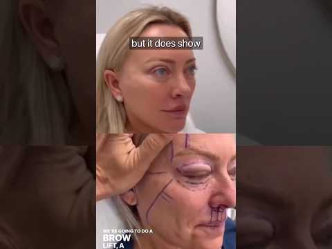 INCREDIBLE Facelift Results | Surgeon Reacts