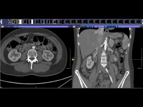 How to read an Aortic Runoff