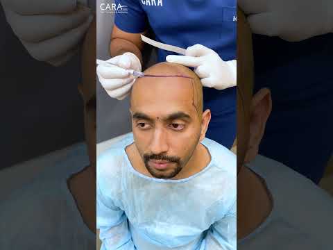 Discover Cara Clinic's AFFORDABLE Hair Transplant Solutions in India!