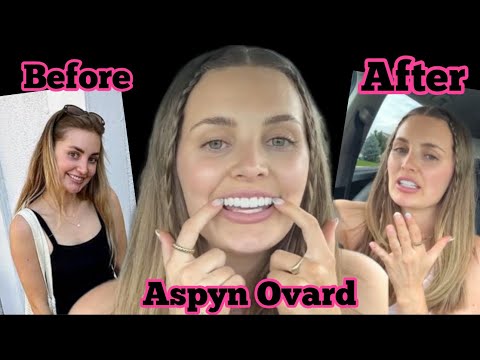 Aspyn Ovard Got VENEERS….before & after