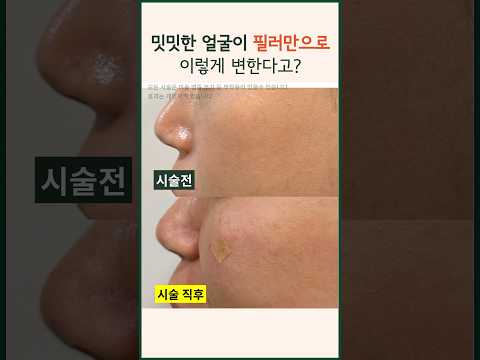 앞볼꺼짐 이마 필러로 이정도 볼륨 가능? 전후 비교 즉각적인 효과  #modsclinic #모즈의원 #필러